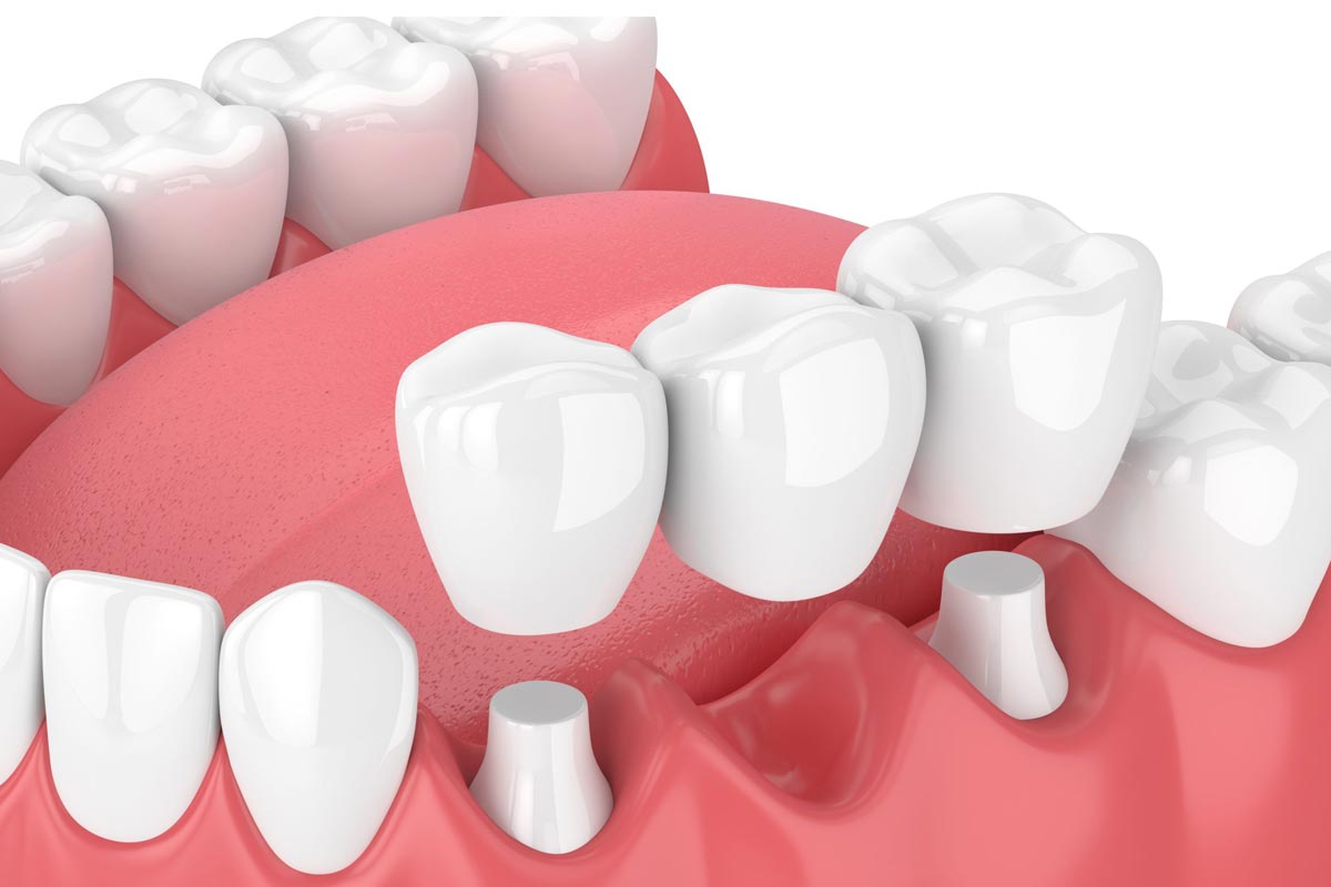 Bridge prosthesis as a tooth replacement