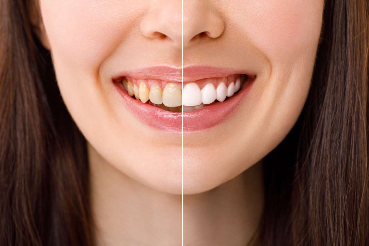 Teeth whitening Zurich